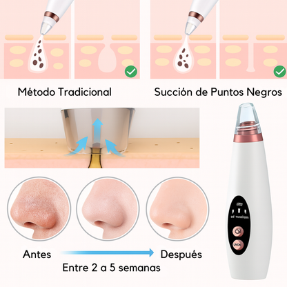 Extractor Puntos Negros Con Cabezales Removibles FlexShop